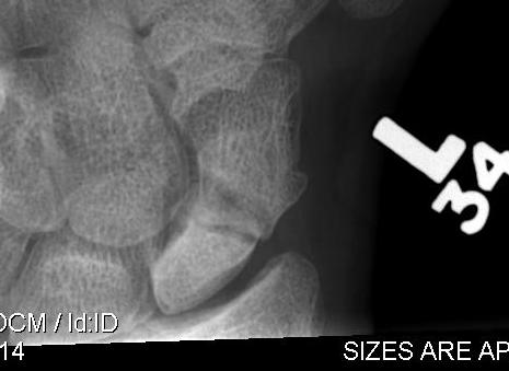 Scaphoid Fracture Proximal Pole AVN